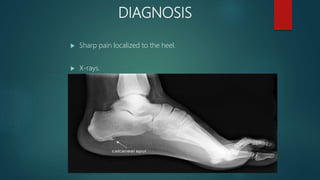 DIAGNOSIS
 Sharp pain localized to the heel.
 X-rays.
 