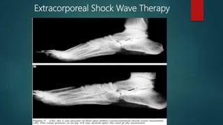 Extracorporeal Shock Wave Therapy
 