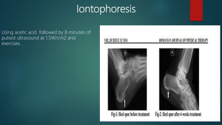 Iontophoresis
Using acetic acid followed by 8 minutes of
pulsed ultrasound at 1.5W/cm2 and
exercises.
 