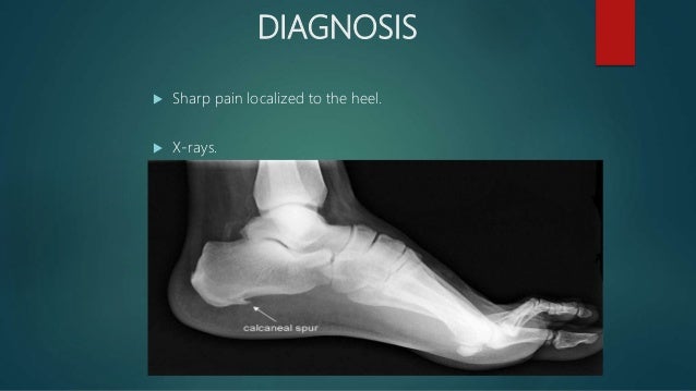 callus crack