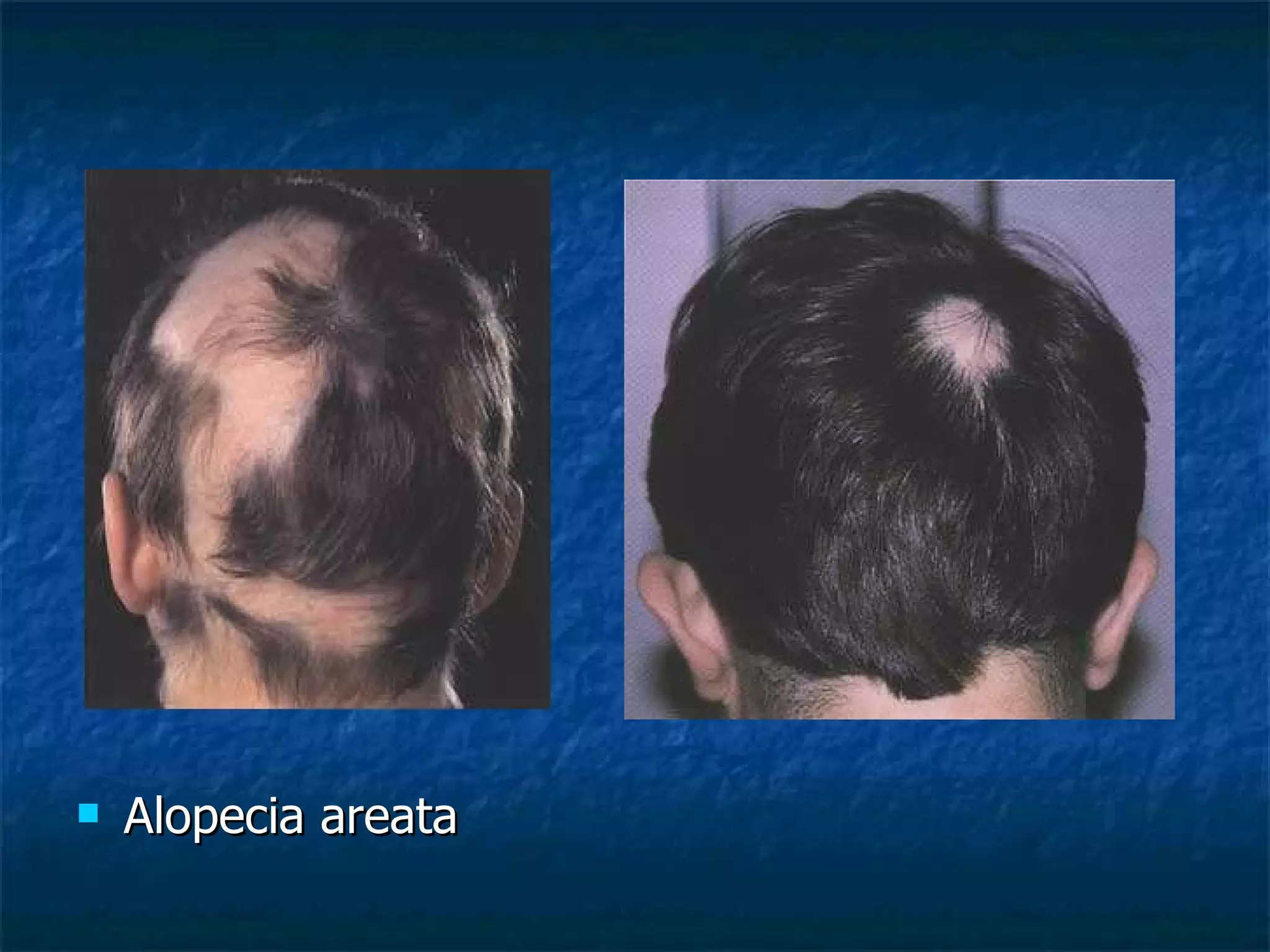 Alopecia areata 