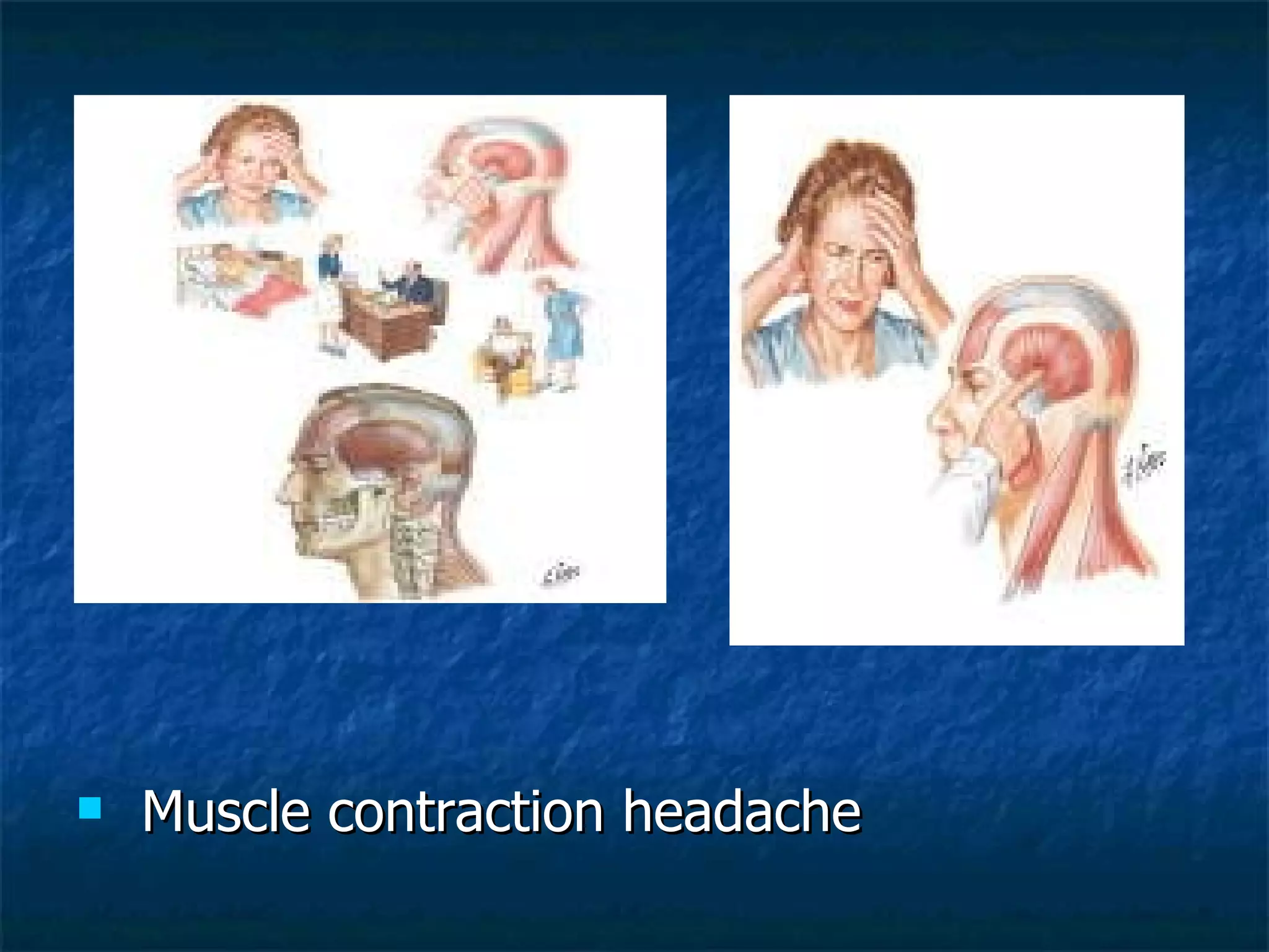 Muscle contraction headache 