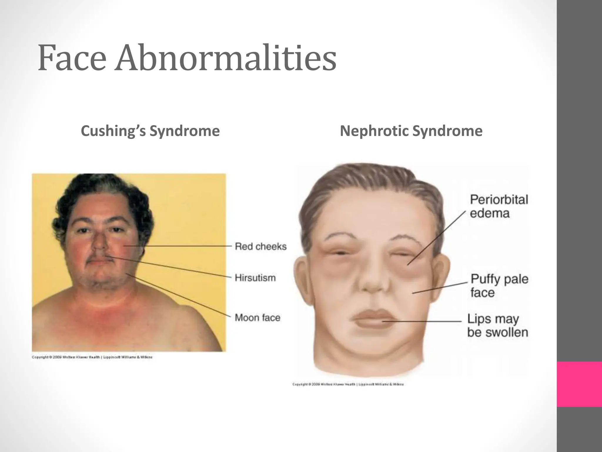 Face Abnormalities
Cushing’s Syndrome Nephrotic Syndrome
 