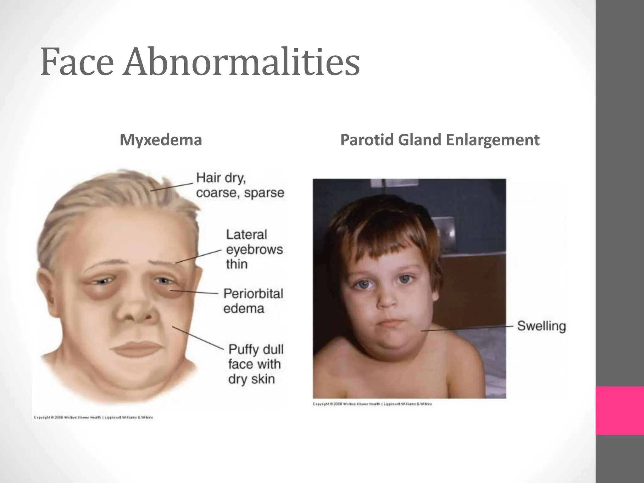 Face Abnormalities
Myxedema Parotid Gland Enlargement
 