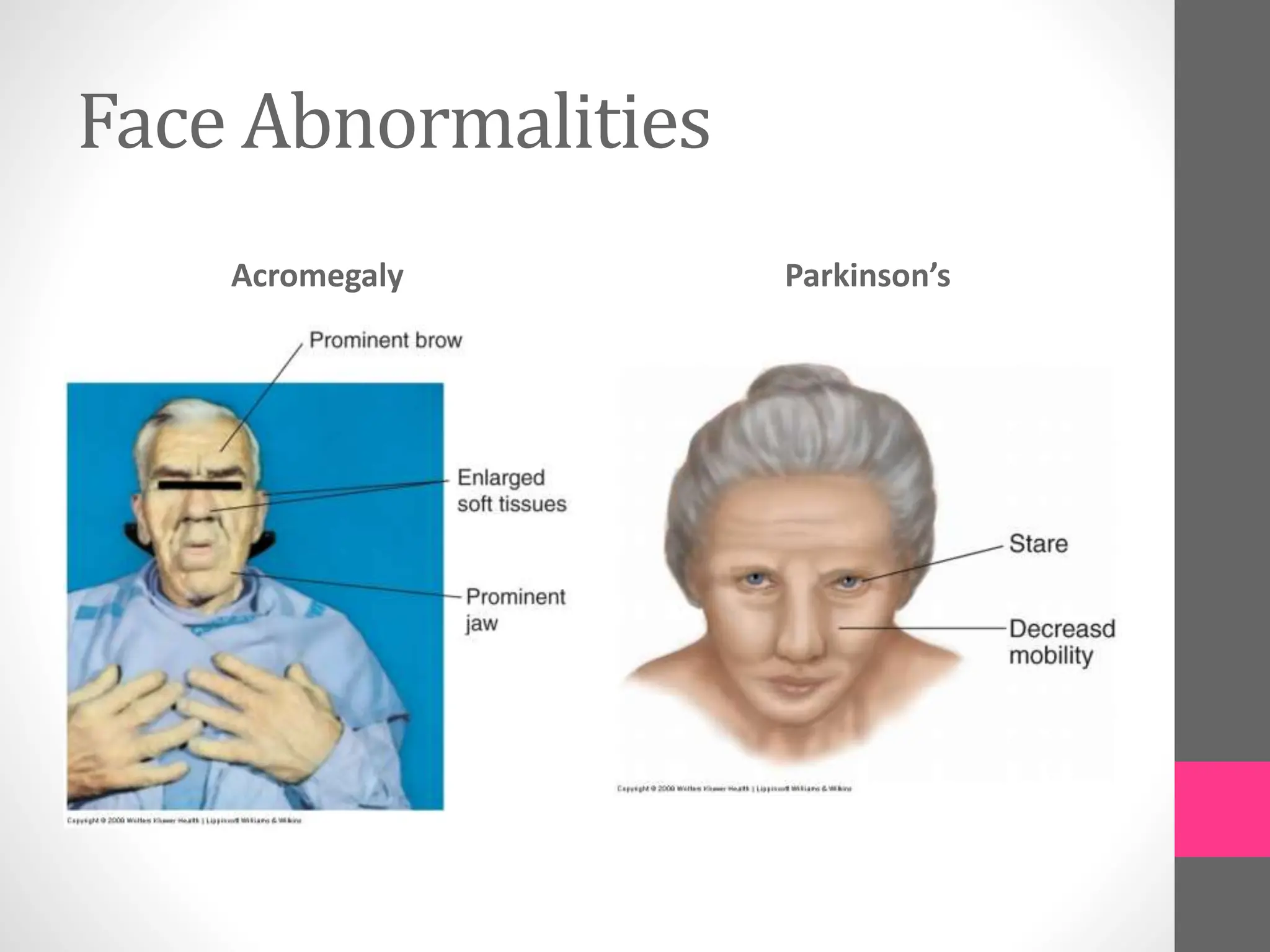 Face Abnormalities
Acromegaly Parkinson’s
 