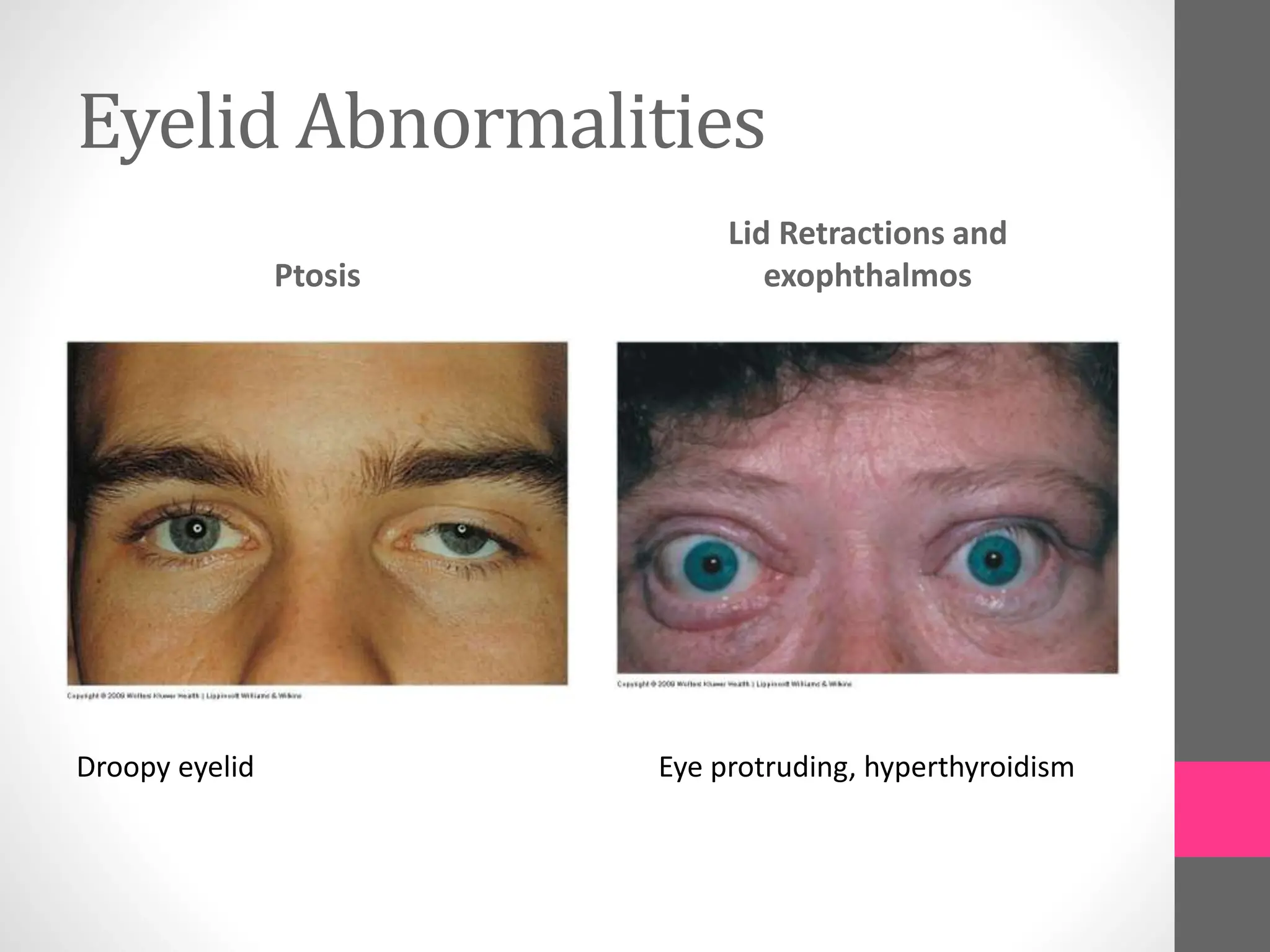 Eyelid Abnormalities
Ptosis
Lid Retractions and
exophthalmos
Droopy eyelid Eye protruding, hyperthyroidism
 