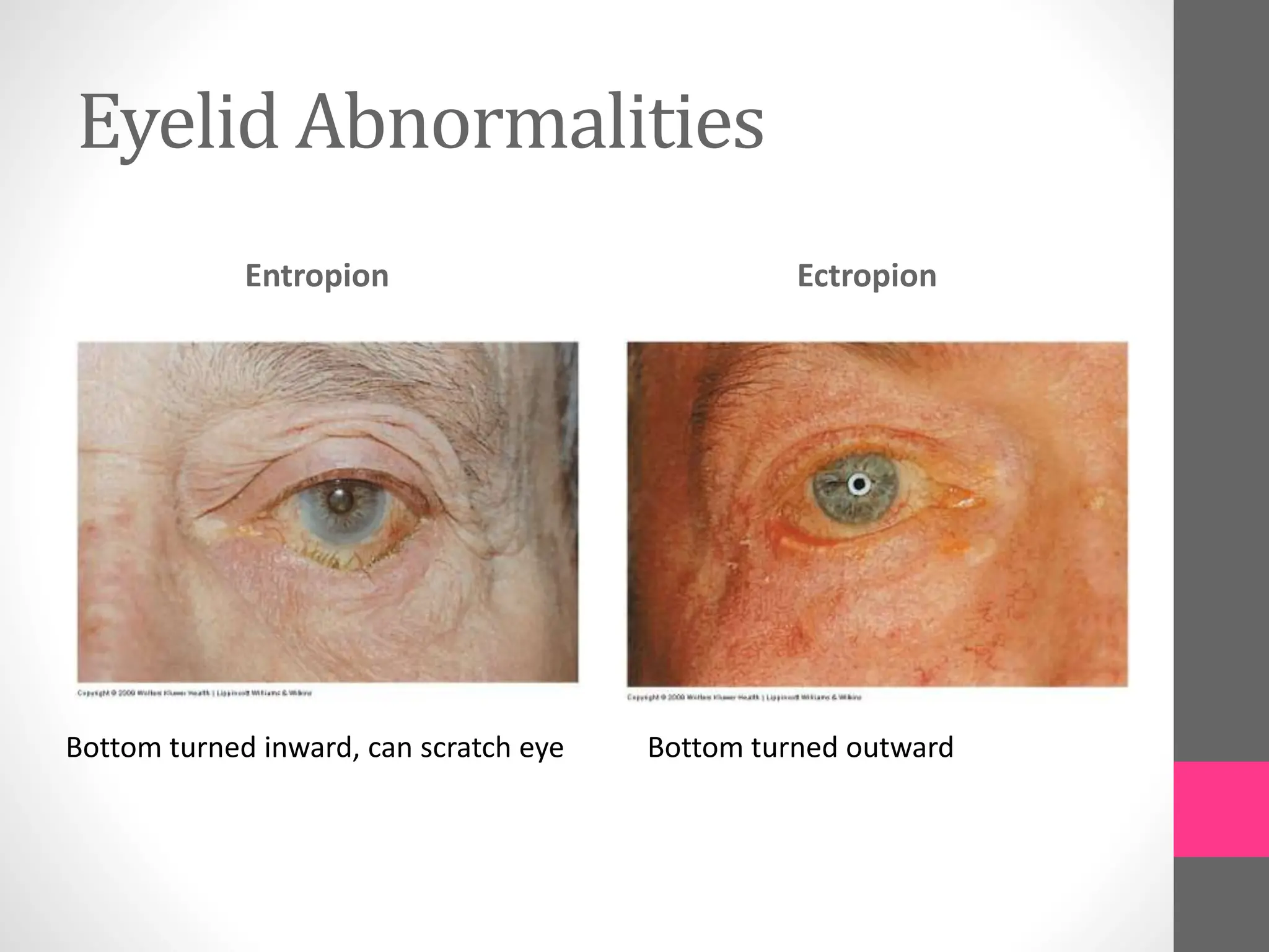 Eyelid Abnormalities
Entropion Ectropion
Bottom turned inward, can scratch eye Bottom turned outward
 