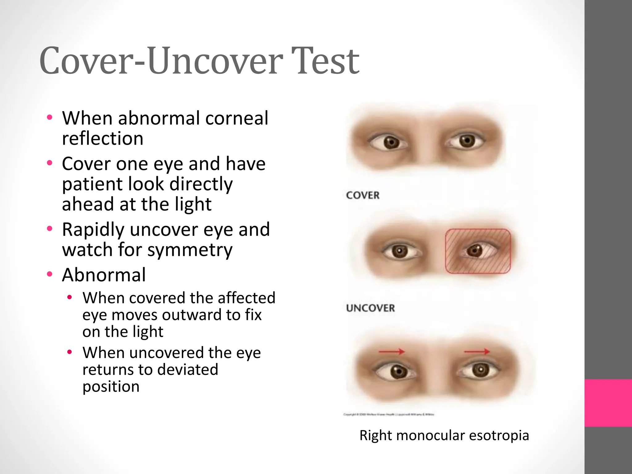 Cover-Uncover Test
• When abnormal corneal
reflection
• Cover one eye and have
patient look directly
ahead at the light
• Rapidly uncover eye and
watch for symmetry
• Abnormal
• When covered the affected
eye moves outward to fix
on the light
• When uncovered the eye
returns to deviated
position
Right monocular esotropia
 