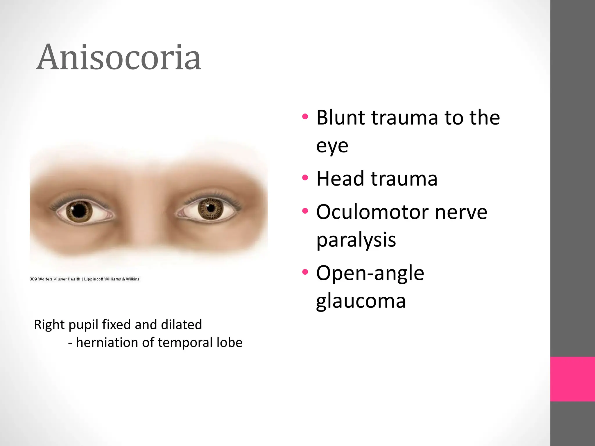 Anisocoria
• Blunt trauma to the
eye
• Head trauma
• Oculomotor nerve
paralysis
• Open-angle
glaucoma
Right pupil fixed and dilated
- herniation of temporal lobe
 