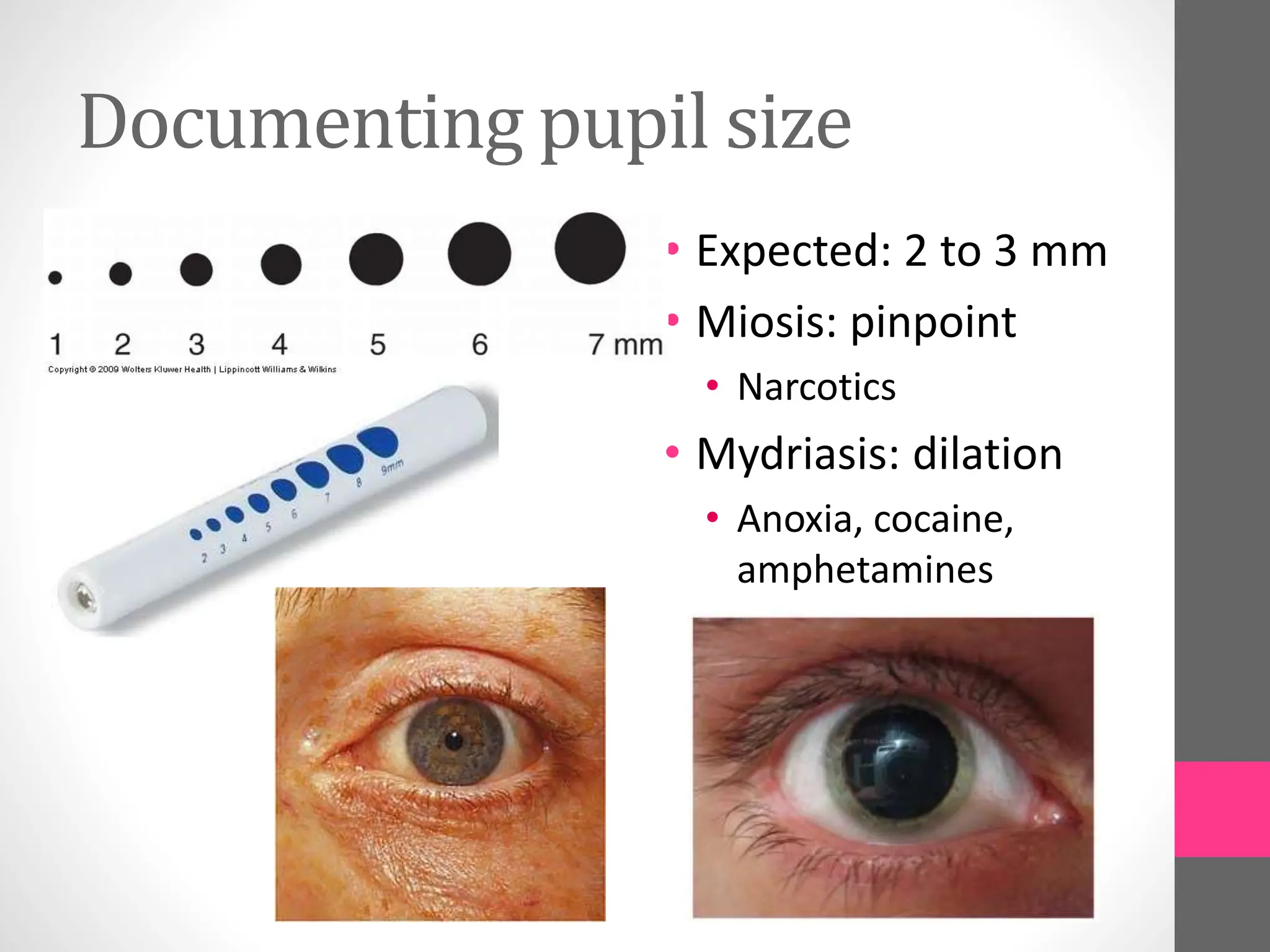 Documenting pupil size
• Expected: 2 to 3 mm
• Miosis: pinpoint
• Narcotics
• Mydriasis: dilation
• Anoxia, cocaine,
amphetamines
 