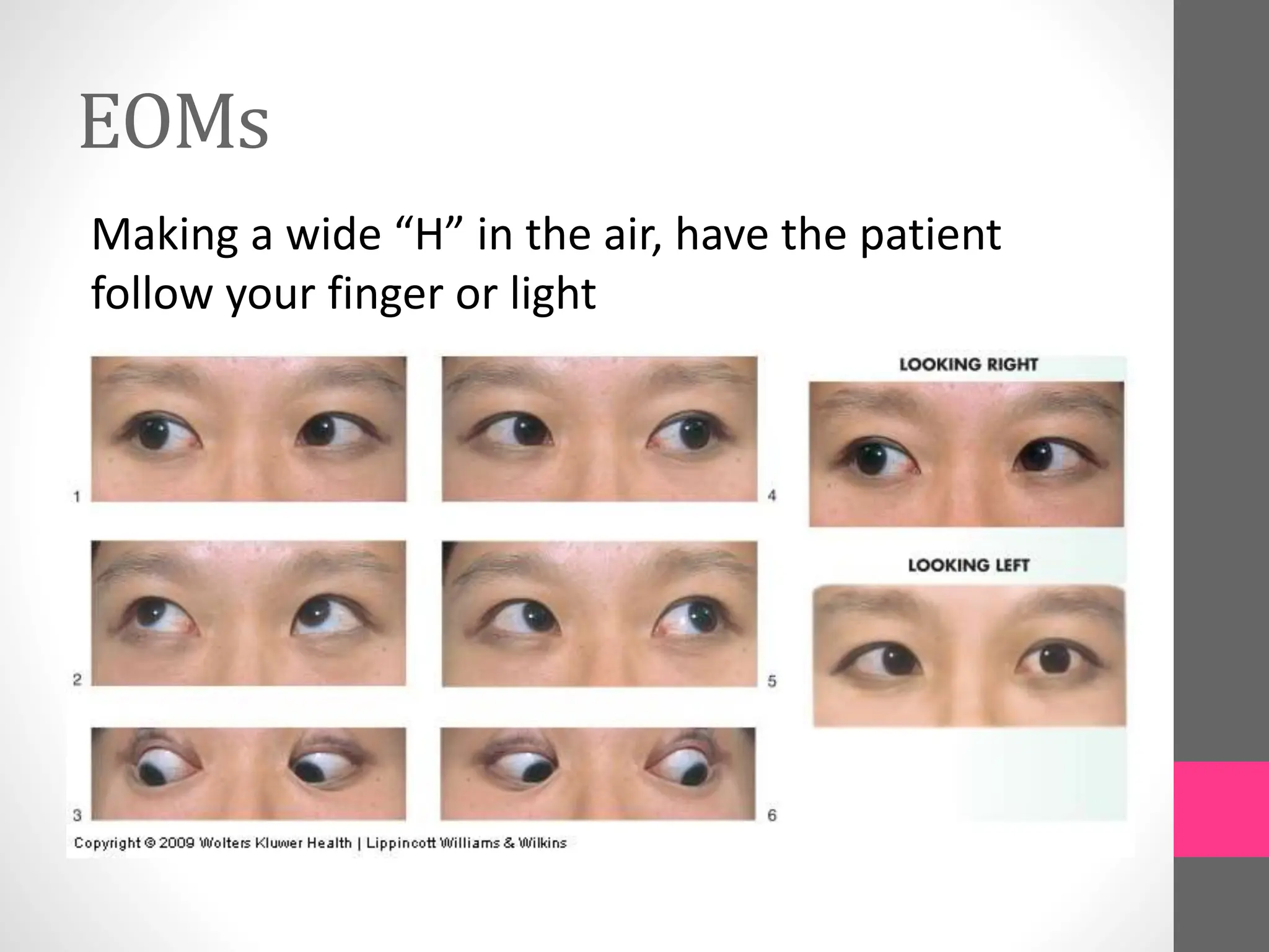 EOMs
Making a wide “H” in the air, have the patient
follow your finger or light
 
