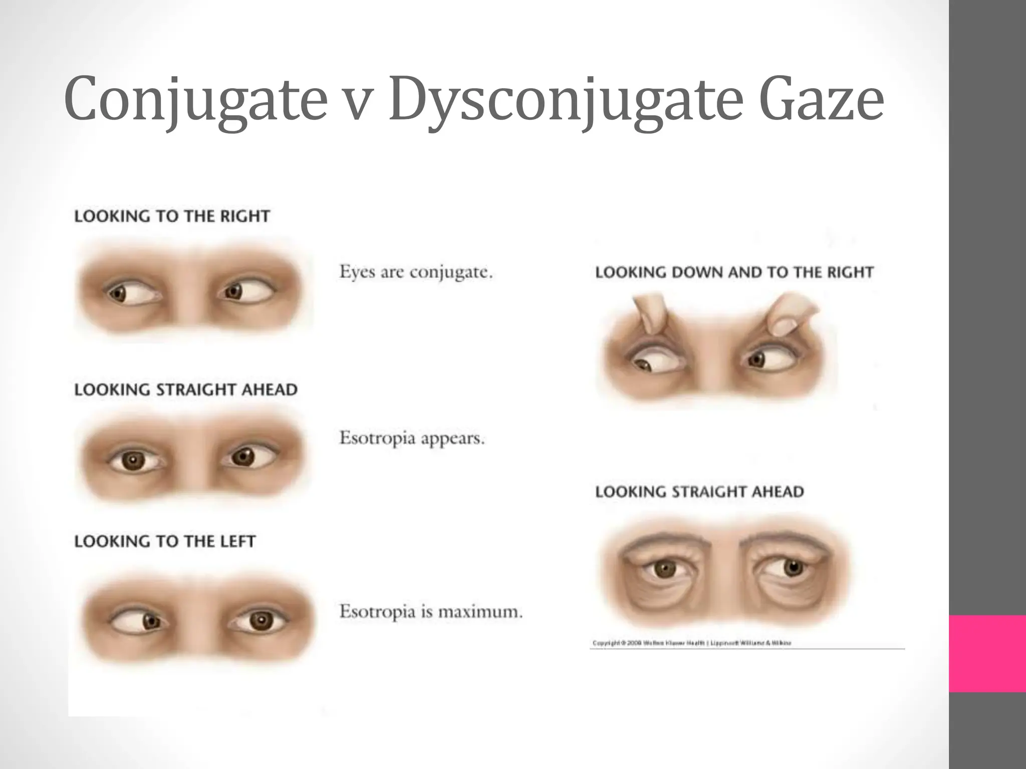 Conjugate v Dysconjugate Gaze
 