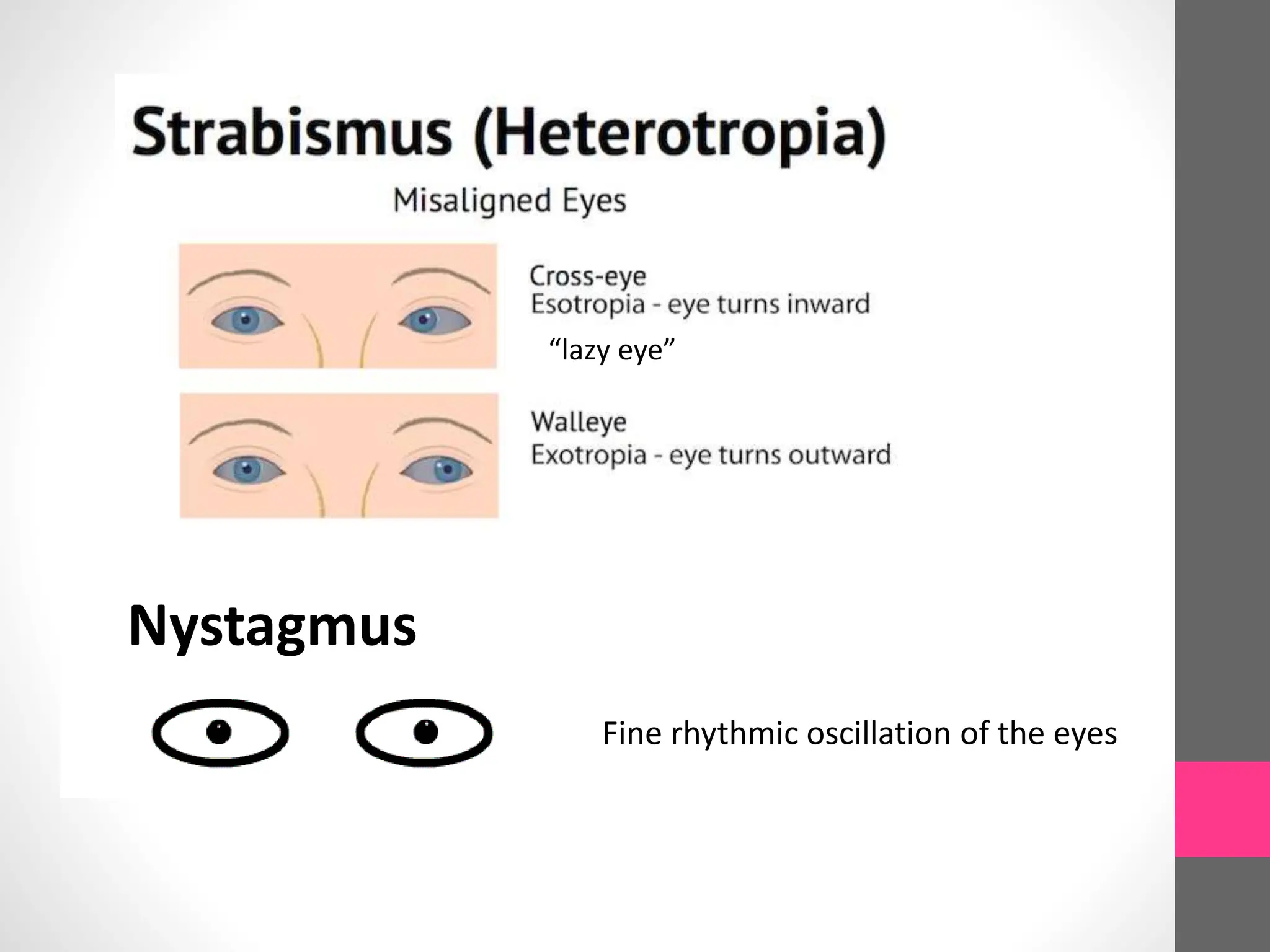 Nystagmus
Fine rhythmic oscillation of the eyes
“lazy eye”
 