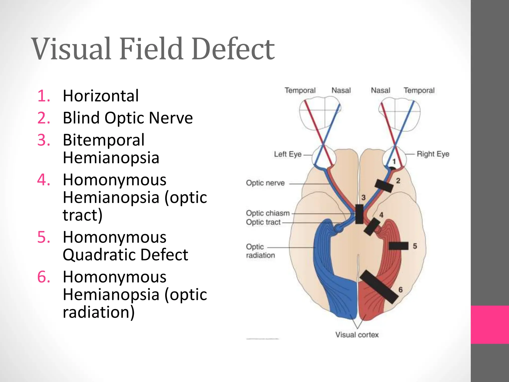 Visual Field Defect
1. Horizontal
2. Blind Optic Nerve
3. Bitemporal
Hemianopsia
4. Homonymous
Hemianopsia (optic
tract)
5. Homonymous
Quadratic Defect
6. Homonymous
Hemianopsia (optic
radiation)
 
