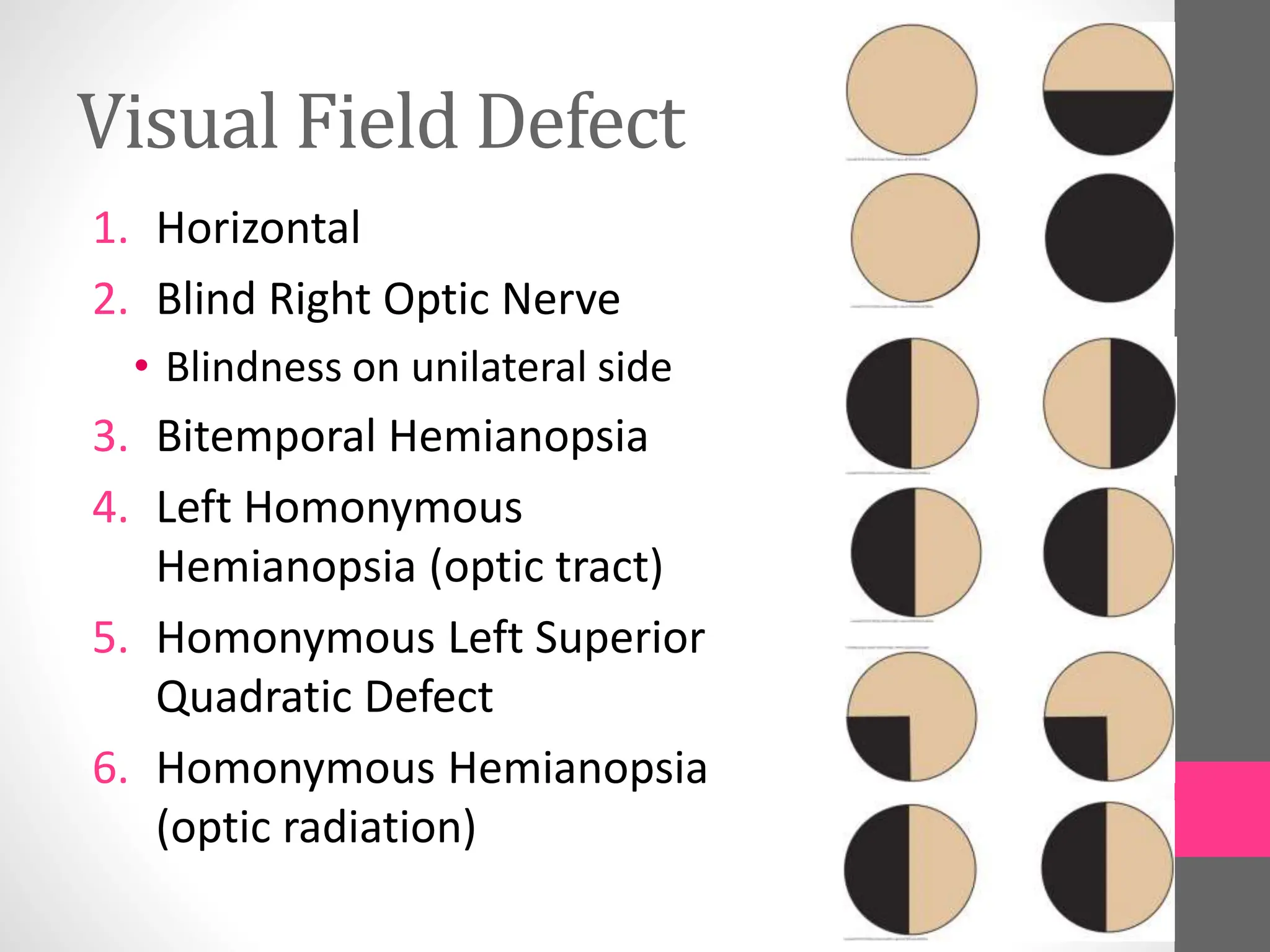 Visual Field Defect
1. Horizontal
2. Blind Right Optic Nerve
• Blindness on unilateral side
3. Bitemporal Hemianopsia
4. Left Homonymous
Hemianopsia (optic tract)
5. Homonymous Left Superior
Quadratic Defect
6. Homonymous Hemianopsia
(optic radiation)
 