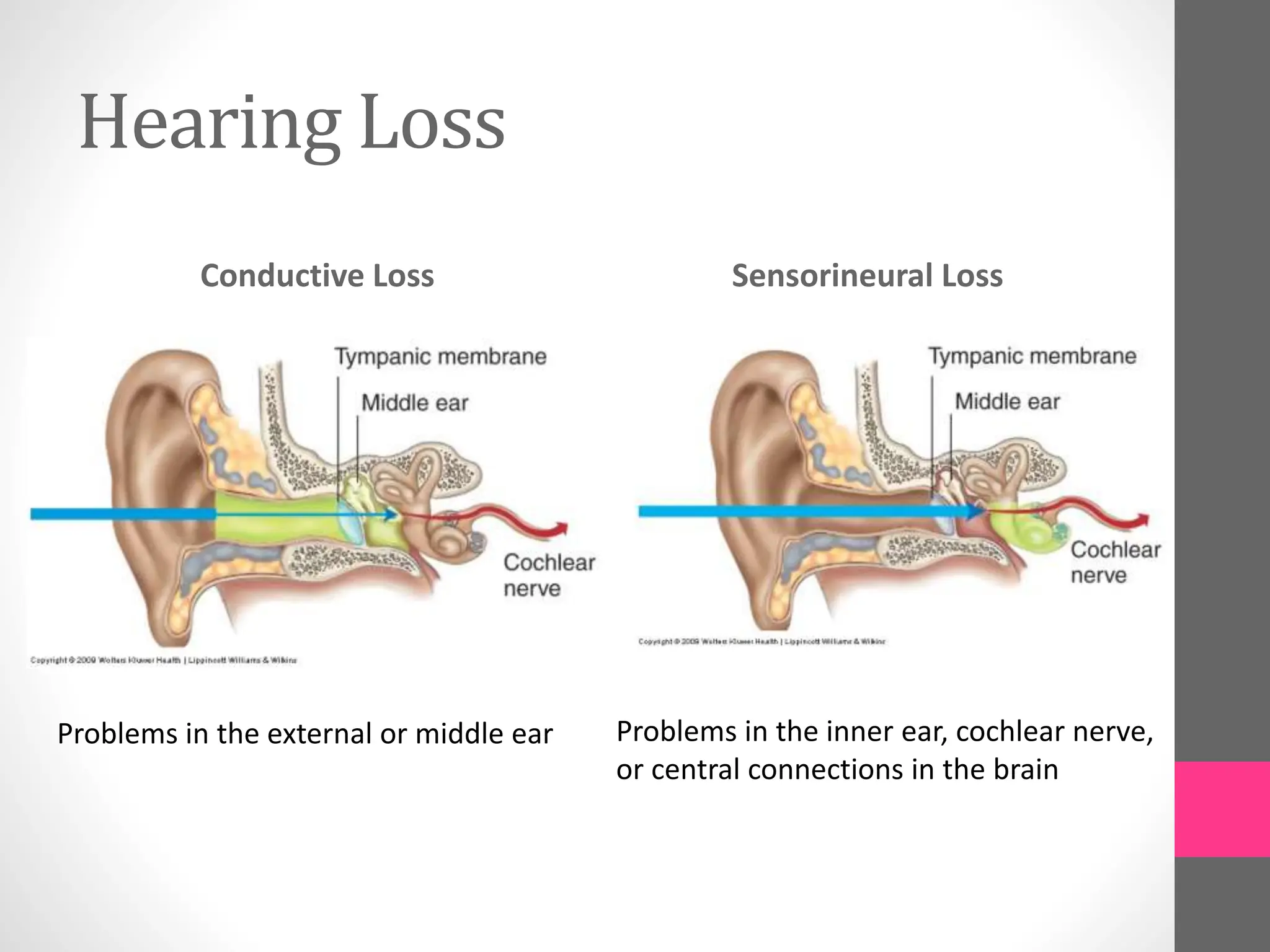 Hearing Loss
Conductive Loss Sensorineural Loss
Problems in the external or middle ear Problems in the inner ear, cochlear nerve,
or central connections in the brain
 