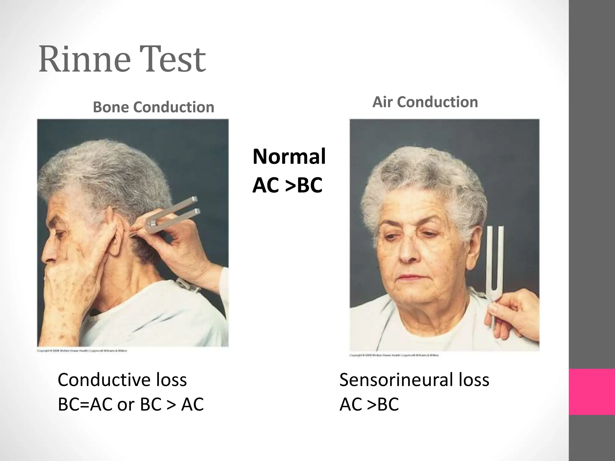 Rinne Test
Bone Conduction Air Conduction
Conductive loss
BC=AC or BC > AC
Sensorineural loss
AC >BC
Normal
AC >BC
 