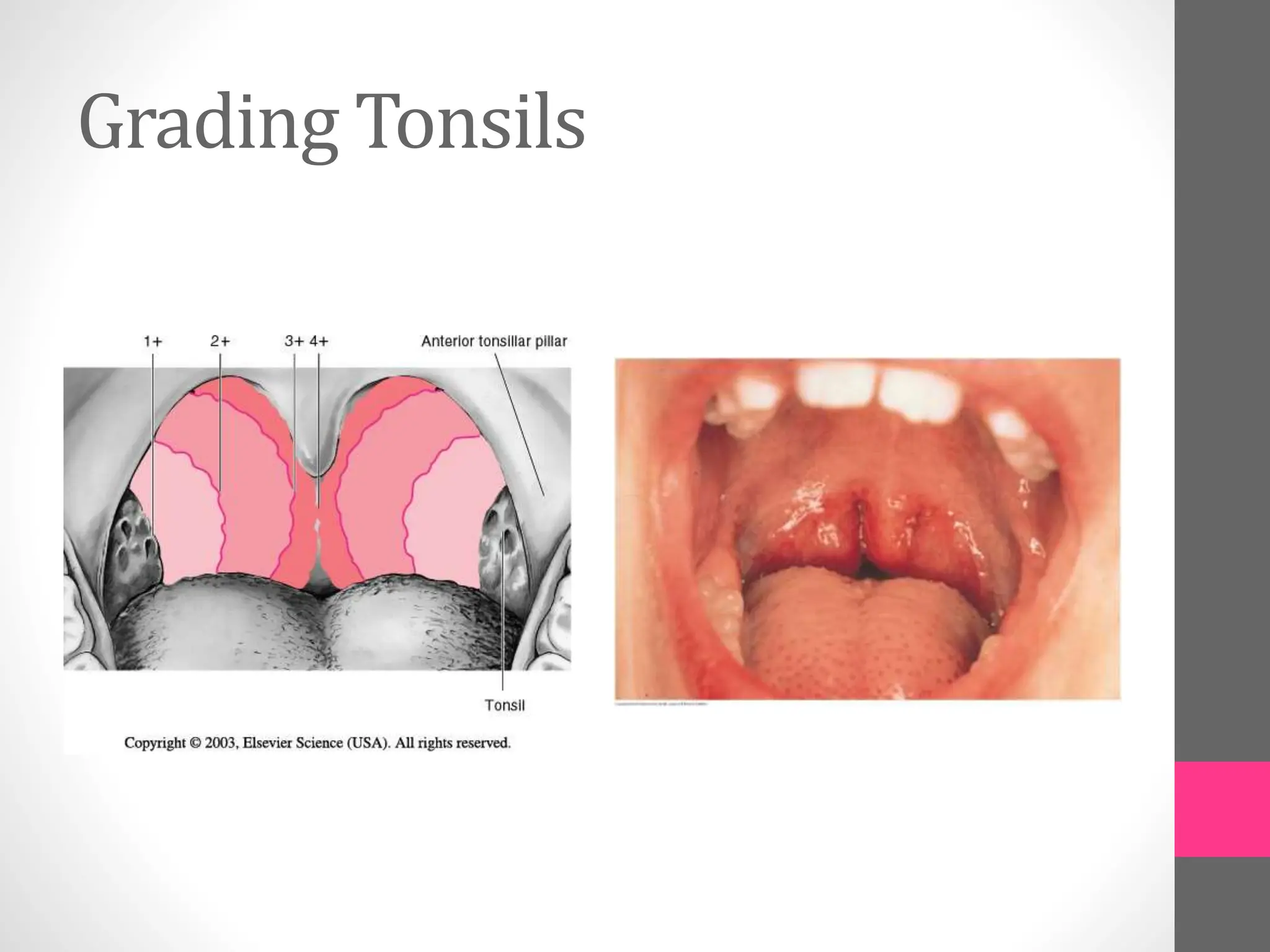 Grading Tonsils
 