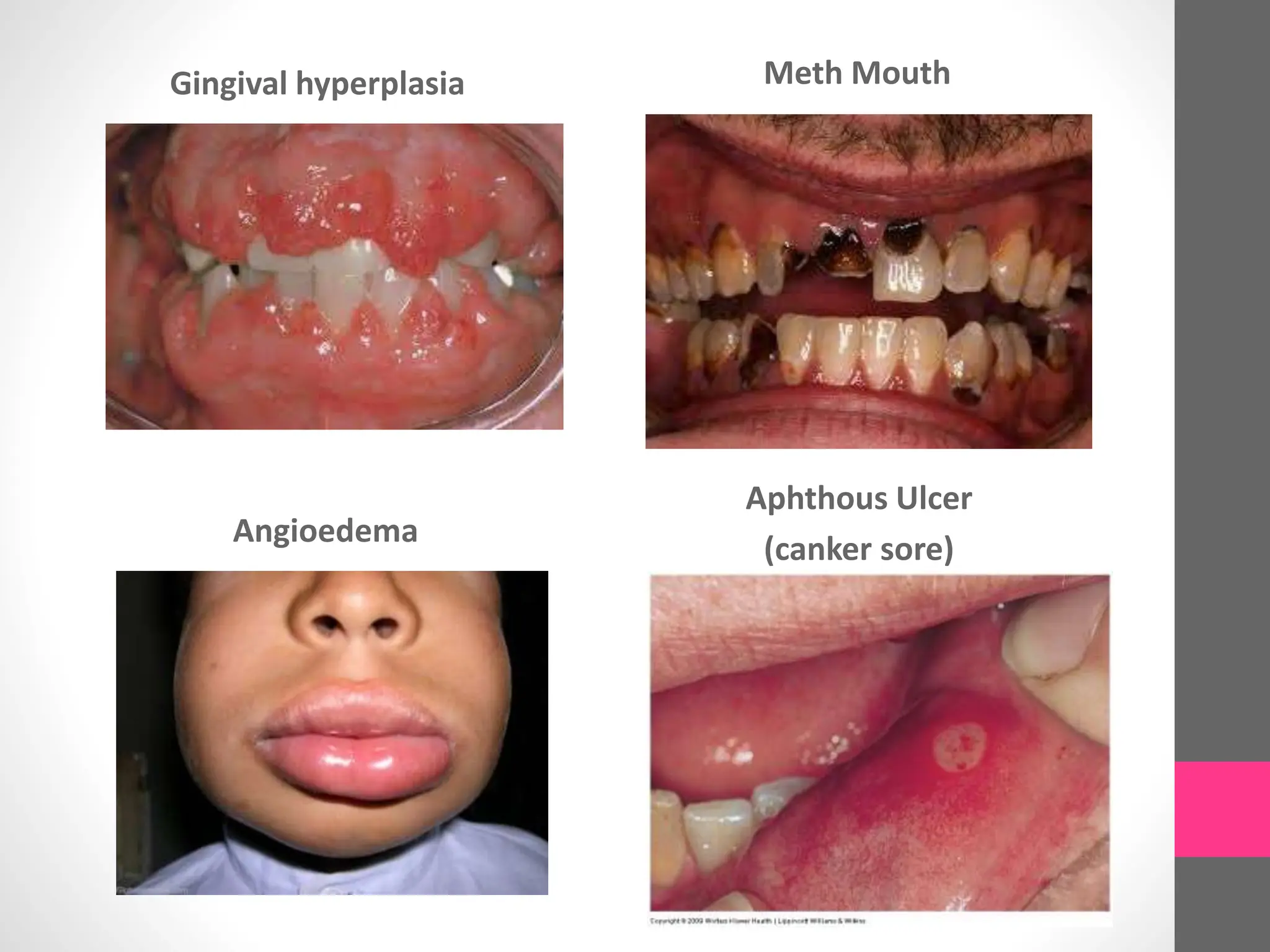 Gingival hyperplasia Meth Mouth
Angioedema
Aphthous Ulcer
(canker sore)
 