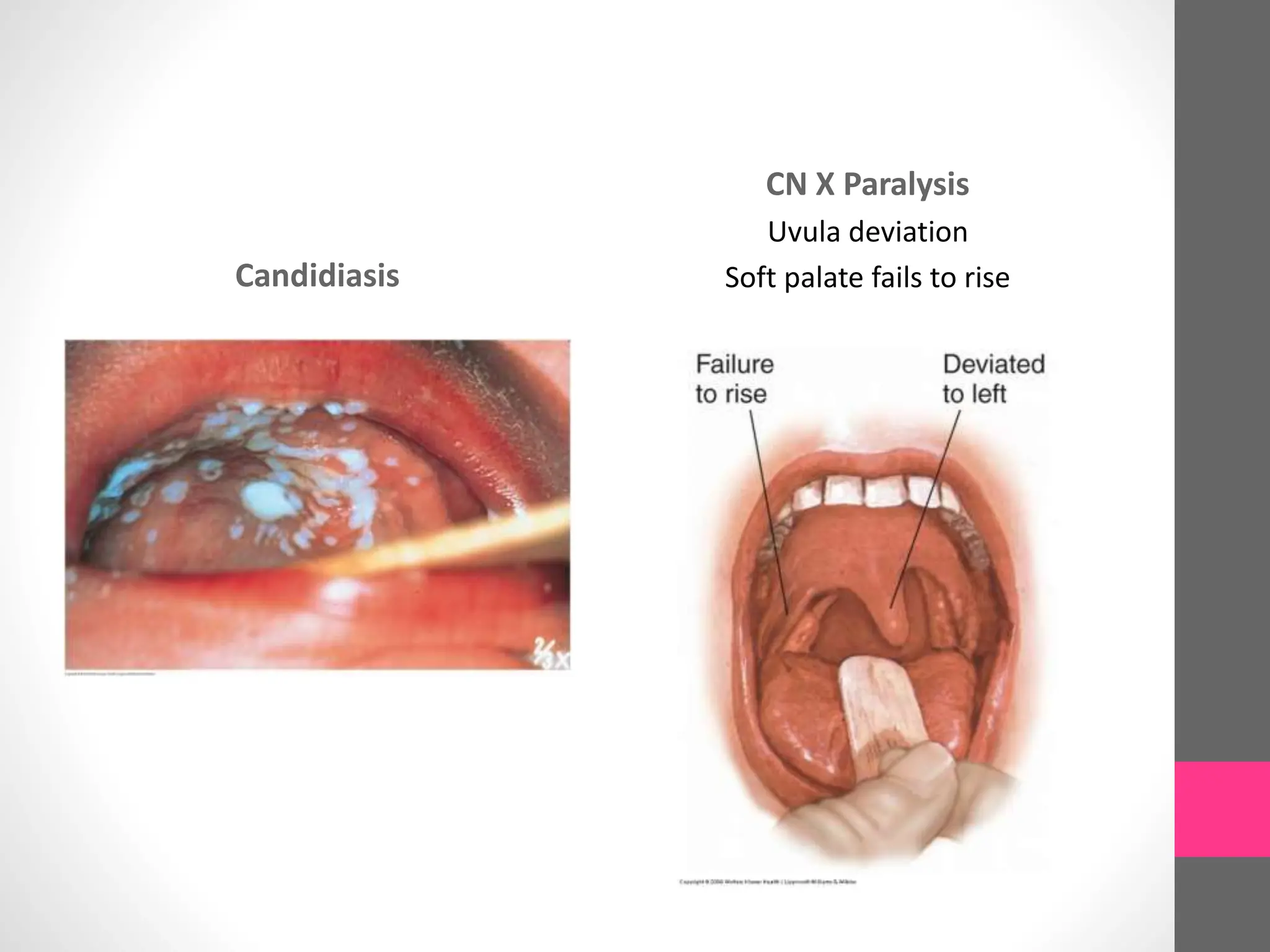 Candidiasis
CN X Paralysis
Uvula deviation
Soft palate fails to rise
 