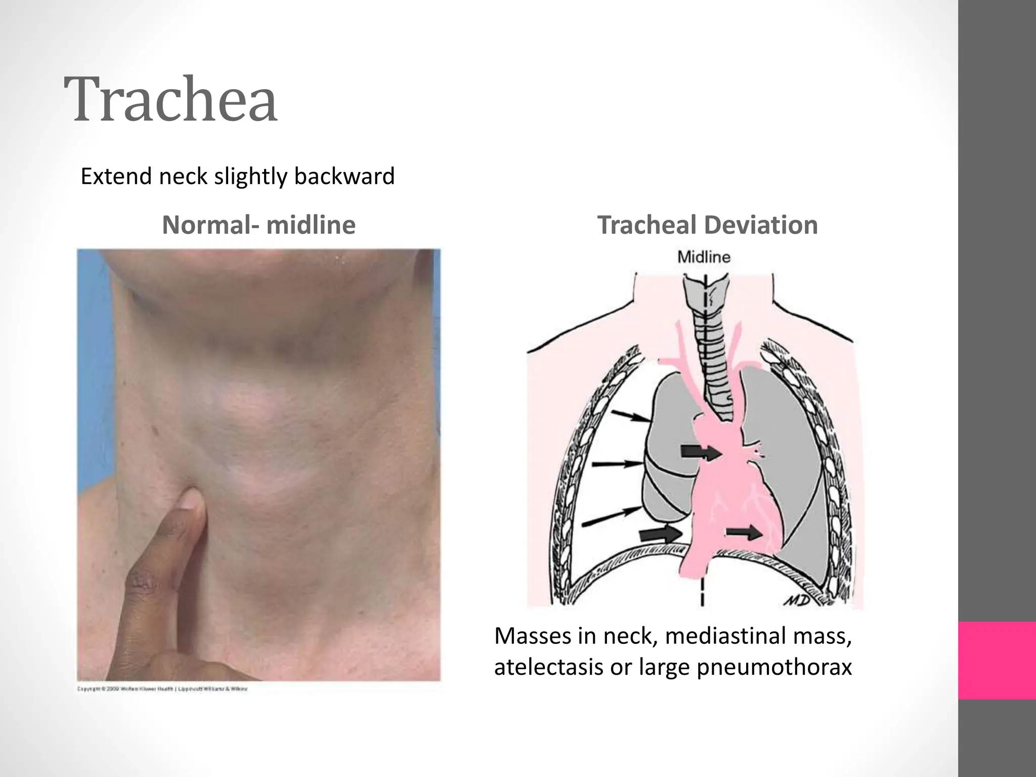 Trachea
Normal- midline Tracheal Deviation
Extend neck slightly backward
Masses in neck, mediastinal mass,
atelectasis or large pneumothorax
 