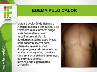EDEMA PELO CALOR
Marca a evolução da doença o
inchaço dos pés e tornozelos, e às
vezes das mãos também surge
mais frequentemente em
trabalhadores ainda não
devidamente aclimatados. Neste
caso poderão ocorrer duas
situações: que os efeitos
desapareçam gradativamente, ou
tendam a se agravar; no último
caso será aconselhável a remoção
do indivíduo do local,
remanejando-o para outras
atividades.
 