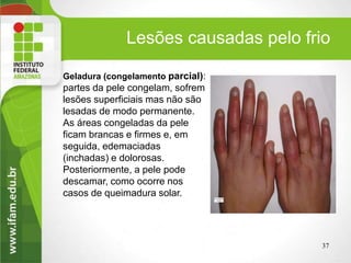 Lesões causadas pelo frio
37
Geladura (congelamento parcial):
partes da pele congelam, sofrem
lesões superficiais mas não são
lesadas de modo permanente.
As áreas congeladas da pele
ficam brancas e firmes e, em
seguida, edemaciadas
(inchadas) e dolorosas.
Posteriormente, a pele pode
descamar, como ocorre nos
casos de queimadura solar.
 
