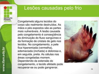 Lesões causadas pelo frio
Congelameto:alguns tecidos do
corpo são realmente destruídos. As
mãos e pés expostos são as partes
mais vulneráveis. A lesão causada
pelo congelamento é conseqüência
da diminuição do fluxo sangüíneo e
da formação de cristais de gelo nos
tecidos. No congelamento, a pele
fica hiperemiada (vermelha),
edemaciada (inchada) e dolorosa e,
em seguida, preta. As células nas
áreas congeladas morrem.
Dependendo da extensão do
congelamento, o tecido afetado pode
recuperar-se ou pode gangrenar.
38
 