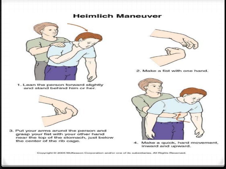 Heimlichs manuever
