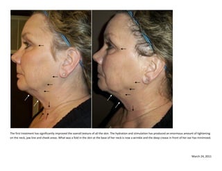 The first treatment has significantly improved the overall texture of all the skin. The hydration and stimulation has produced an enormous amount of tightening
on the neck, jaw line and cheek areas. What was a fold in the skin at the base of her neck is now a wrinkle and the deep crease in front of her ear has minimized.




                                                                                                                                                  March 24, 2011
 