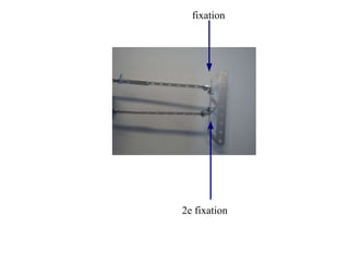 fixation
2e fixation