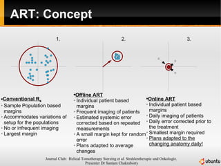 ART: Concept Conventional R x Sample Population based margins  Accommodates variations of setup for the populations No or infrequent imaging Largest margin Offline ART Individual patient based margins Frequent imaging of patients Estimated systemic error corrected based on repeated measurements A small margin kept for random error Plans adapted to average changes Online ART Individual patient based margins Daily imaging of patients Daily error corrected prior to the treatment Smallest margin required Plans adapted to the changing anatomy daily! 1. 2. 3. 
