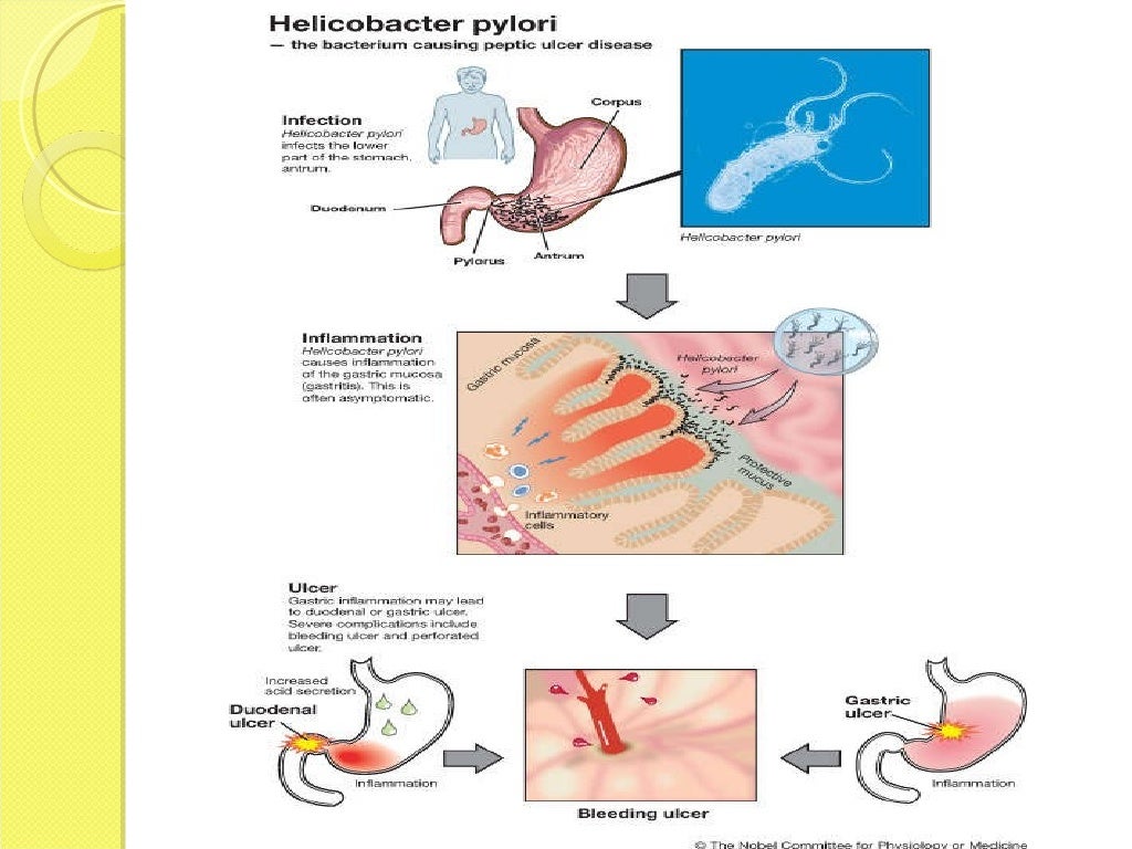 Helicobacter Pylori