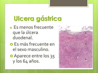  Es menos frecuente
que la úlcera
duodenal.
 Es más frecuente en
el sexo masculino.
 Aparece entre los 35
y los 64 años.
Ulcera gástrica
 