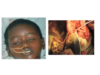 Nematelmintos
Ascaridíase
 