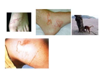 Dermatite pruriginosa




        Agente etiológico:
        Ancylostoma brasiliensis

        - Região subcutânea
        - Penetração ativa da larva
 