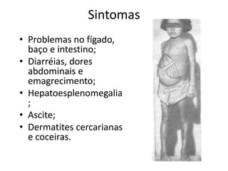 Sintomas
• Problemas no fígado,
  baço e intestino;
• Diarréias, dores
  abdominais e
  emagrecimento;
• Hepatoesplenomegalia
  ;
• Ascite;
• Dermatites cercarianas
  e coceiras.
 