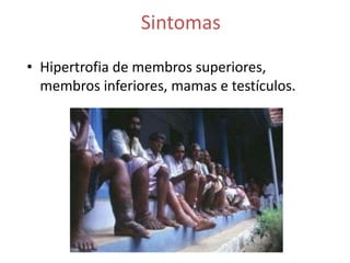 Sintomas
• Hipertrofia de membros superiores,
  membros inferiores, mamas e testículos.
 