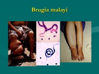 Brugia malayi
 