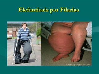 Elefantiasis por Filarias
 
