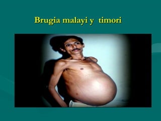 Brugia malayi y timori
 