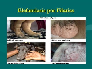 Elefantiasis por Filarias
 