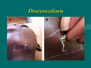 Dracunculiasis
 