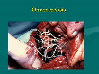 Oncocercosis
 