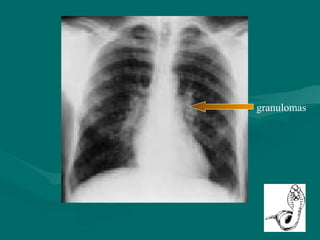 granulomas
 