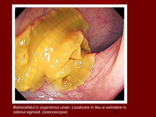Botriocefalul in organismul uman. Localizare in Ileu si extindere in
colonul sigmoid. (colonoscopie)                              30
 
