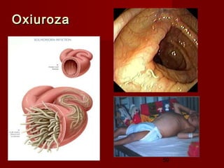 Oxiuroza




           59
 