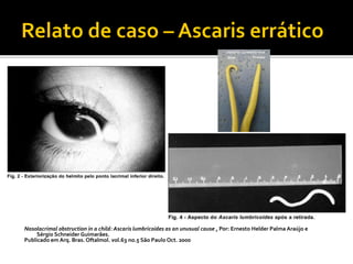 Nasolacrimal obstruction in a child: Ascaris lumbricoides as an unusual cause , Por: Ernesto Helder Palma Araújo e
Sérgio Schneider Guimarães.
Publicado em Arq. Bras. Oftalmol. vol.63 no.5 São Paulo Oct. 2000
 
