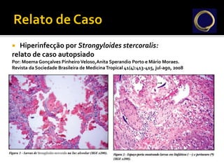 Hiperinfecção por Strongyloides stercoralis:
relato de caso autopsiado
Por: Moema Gonçalves Pinheiro Veloso,Anita Sperandio Porto e Mário Moraes.
Revista da Sociedade Brasileira de MedicinaTropical 41(4):413-415, jul-ago, 2008
 