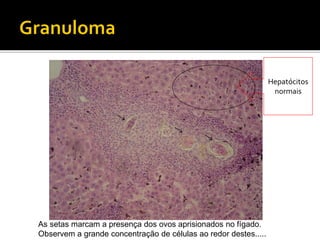 As setas marcam a presença dos ovos aprisionados no fígado.
Observem a grande concentração de células ao redor destes.....
Hepatócitos
normais
 